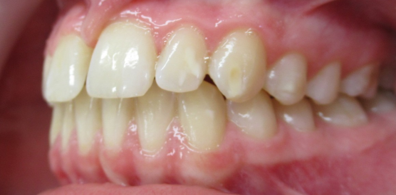 orthodontiste mandelieu la napoule suivi patient Cas clinique Dr Mathelin Christel | Orthodontiste Mandelieu-la-Napoule