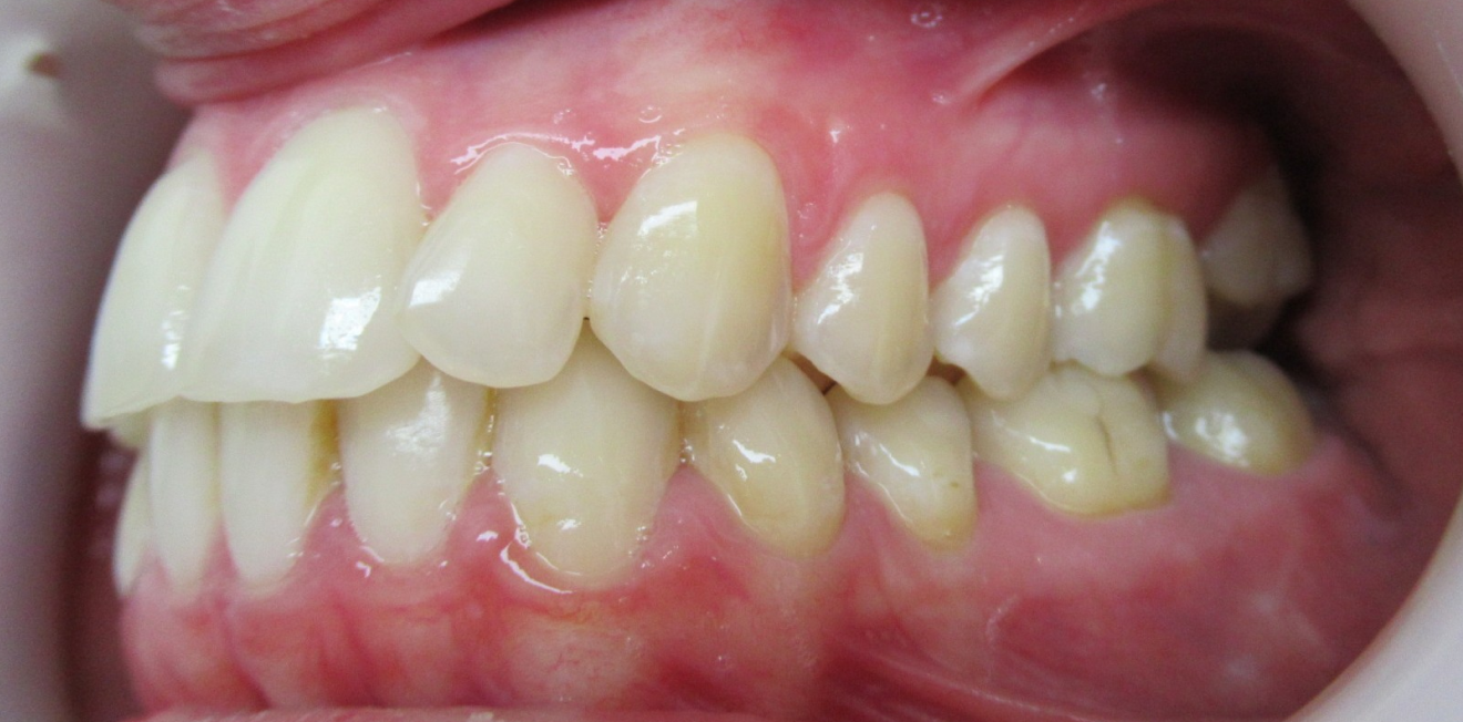 poujois_gouttieres_7_1