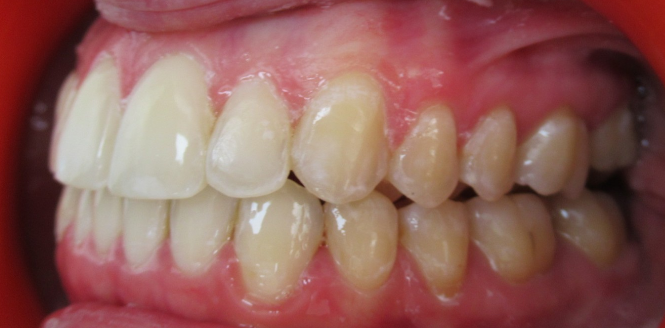 poujois_gouttieres_8_1