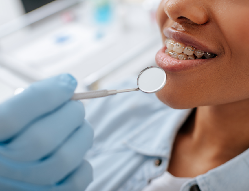 appareils dentaire ceramiques  Dr Mathelin Christel | Orthodontiste Mandelieu-la-Napoule